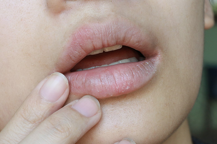 5 Penyakit Bibir Kering Selain Kurang Minum Air Putih