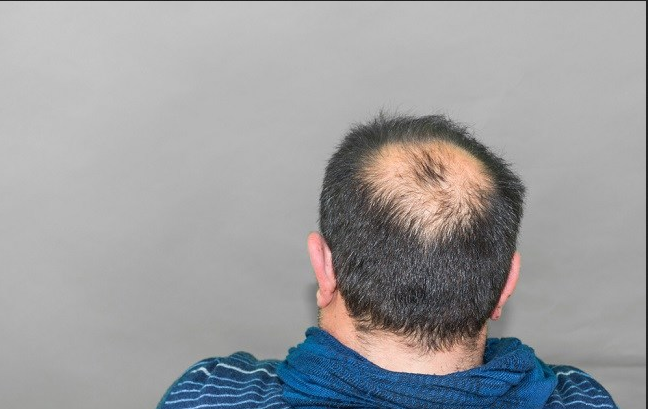 Mengetahui Penyebab Dan Cara Mencegah Terjadinya Alopecia